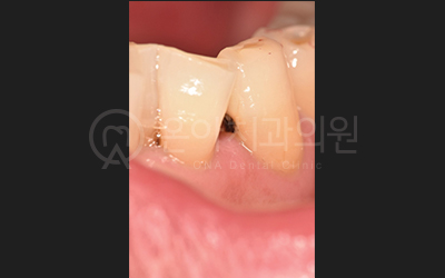 앞니 레진 치료 전 구강 내 사진
