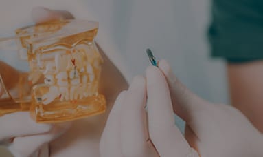 고난도 뼈이식 임플란트 — 치아 모형에 재료를 적용하는 모습